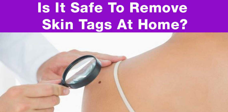 Skin Tag Home Remedies 