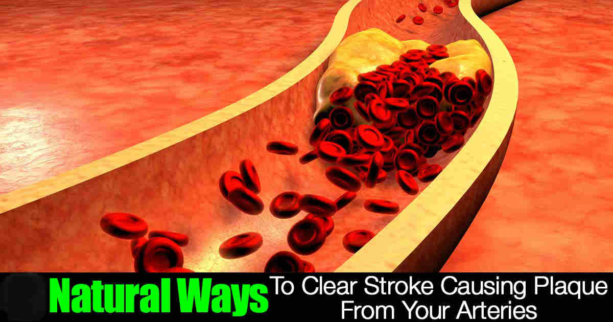 natural-ways-clear- Arteries plaque 