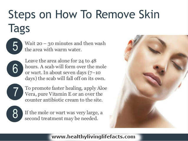 Nevi Skin skin tags remover