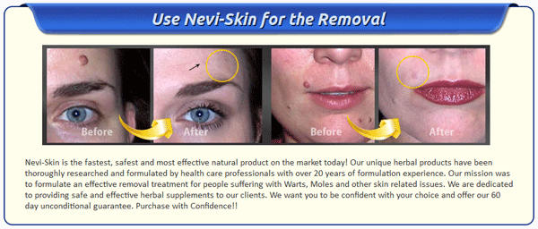 Nevi Skin Mole Removal : 