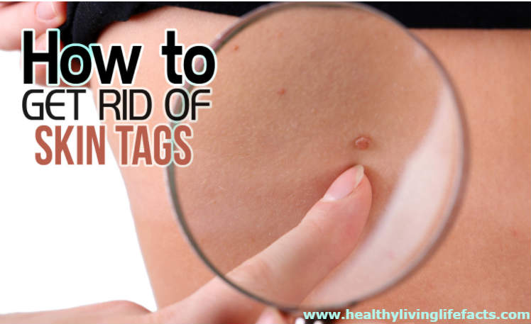 How to Remove Skin Tags, Causes Moles Remover